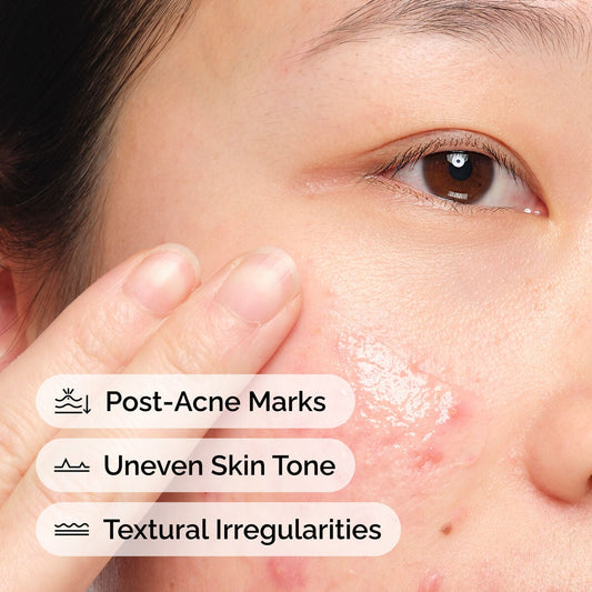 Aloe 2% and NAG 2% Serum for Post-Acne Marks