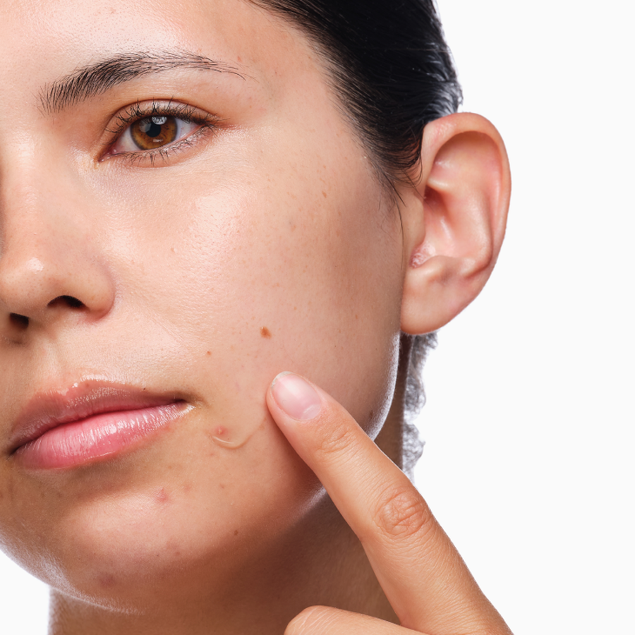 Three-Step Acne Skincare Set with Salicylic Acid 2%
